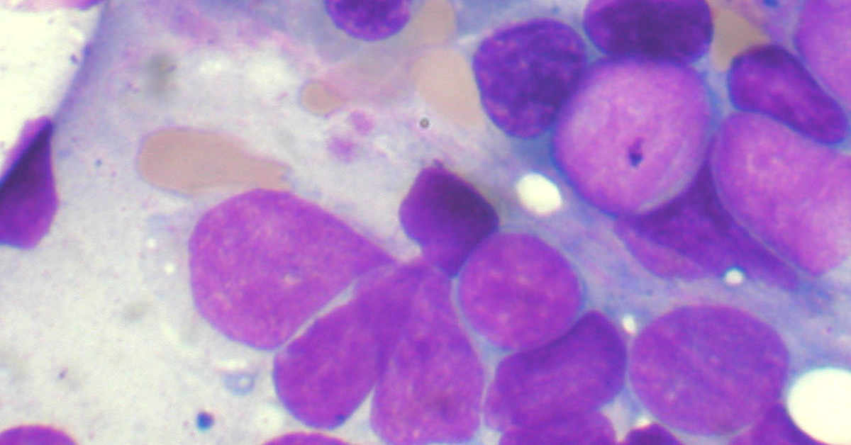 Aspirato di midollo osseo di un ammalato di leucemia mieloide acuta. Nuova terapia accessibile in Italia: la midostaurina
