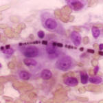 Fibra di asbesto nei tessuti al microscopio