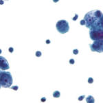 Cellule tumorali del peritoneo al microscopio
