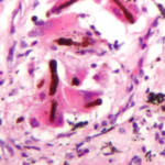 Asbestosi: tessuto al microscopio