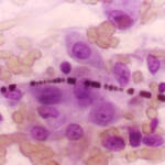 Fibra di asbesto al microscopio in un caso di carcinoma polmonare